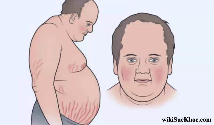 Hội chứng cushing là gì?